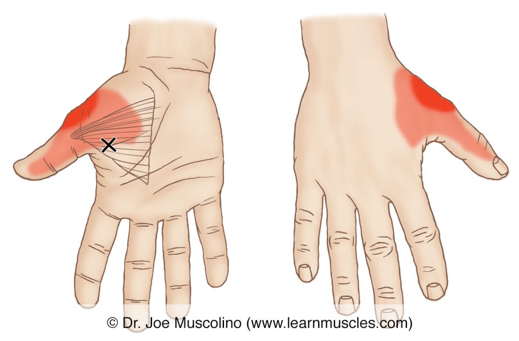 Anterior and posterior views of a myofascial trigger point in the right-side adductor pollicis and its corresponding referral zone.