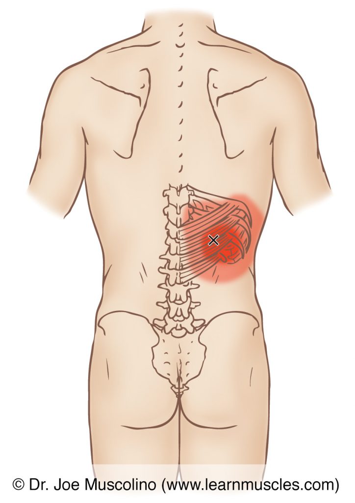 Posterior view of a myofascial trigger point in the right-side serratus posterior inferior and its corresponding referral zone.
