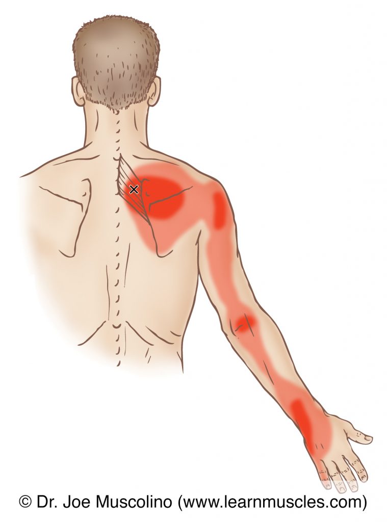 Posterior view of a myofascial trigger point in the right-side serratus posterior superior and its corresponding referral zone.