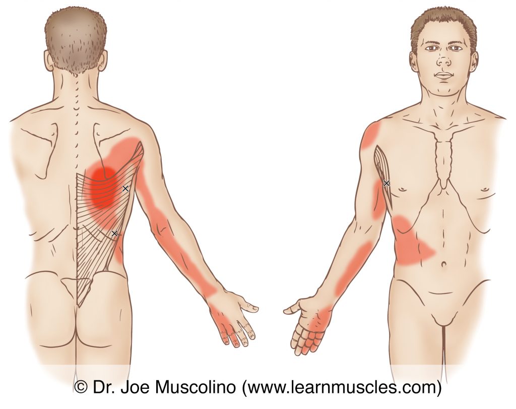 Posterior and anterior views of myofascial trigger points in the right-side latissimus dorsi and their corresponding referral zones.