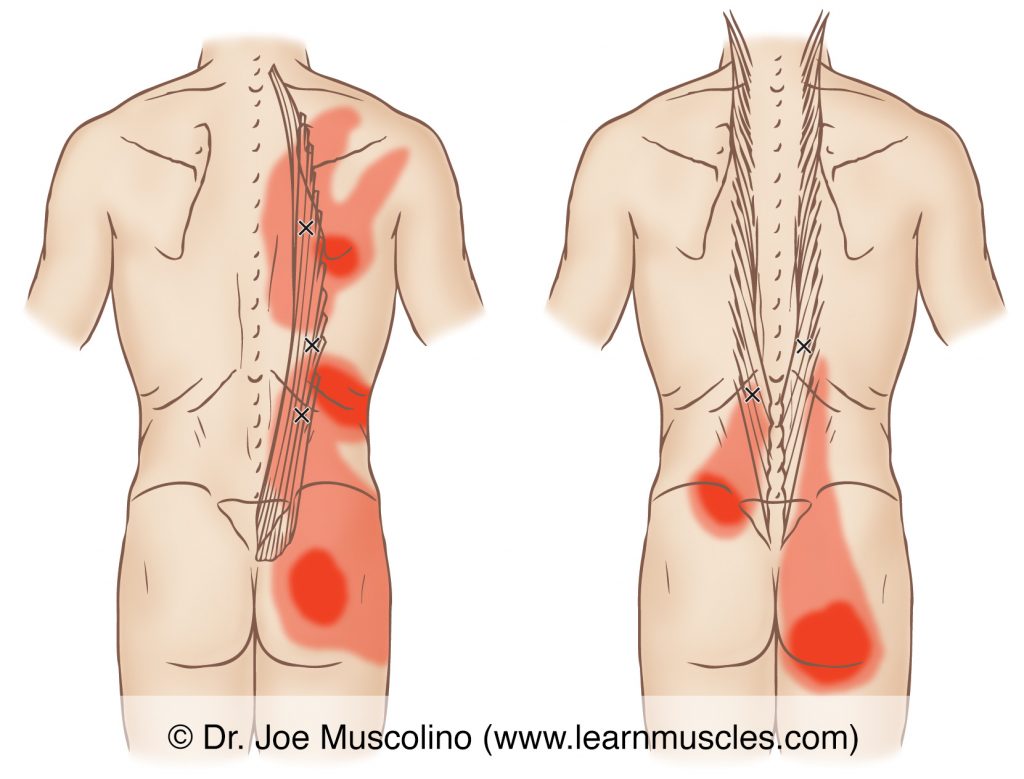 Posterior views of myofascial trigger points in the right-side iliocostalis and longissimus and their corresponding referral zones.