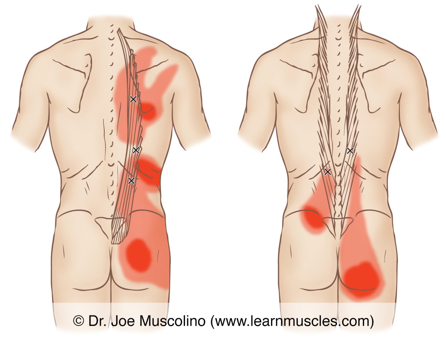 Iliocostalis and Longissimus - Trigger Points - Learn Muscles