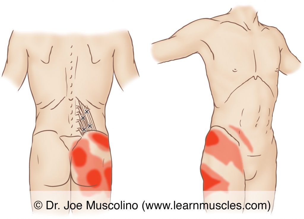 Posterior and anterolateral views of myofascial trigger points in the right-side quadratus lumborum (QL) and their corresponding referral zones.