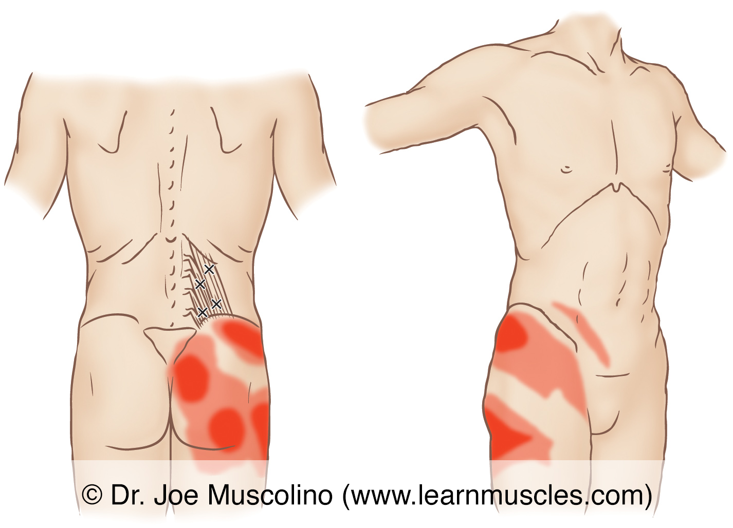 Иррадиация боли в спину. Подвздошно-поясничная мышца триггерные боли. Квадратная поясничная мышца триггерные точки. Синдром квадратной мышцы поясницы. Квадратная мышца поясницы триггерные точки.
