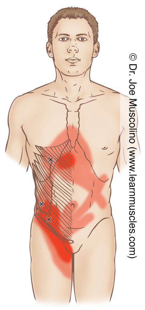 Anterior view of myofascial trigger points in the right-side external and internal abdominal obliques and their corresponding referral zones.