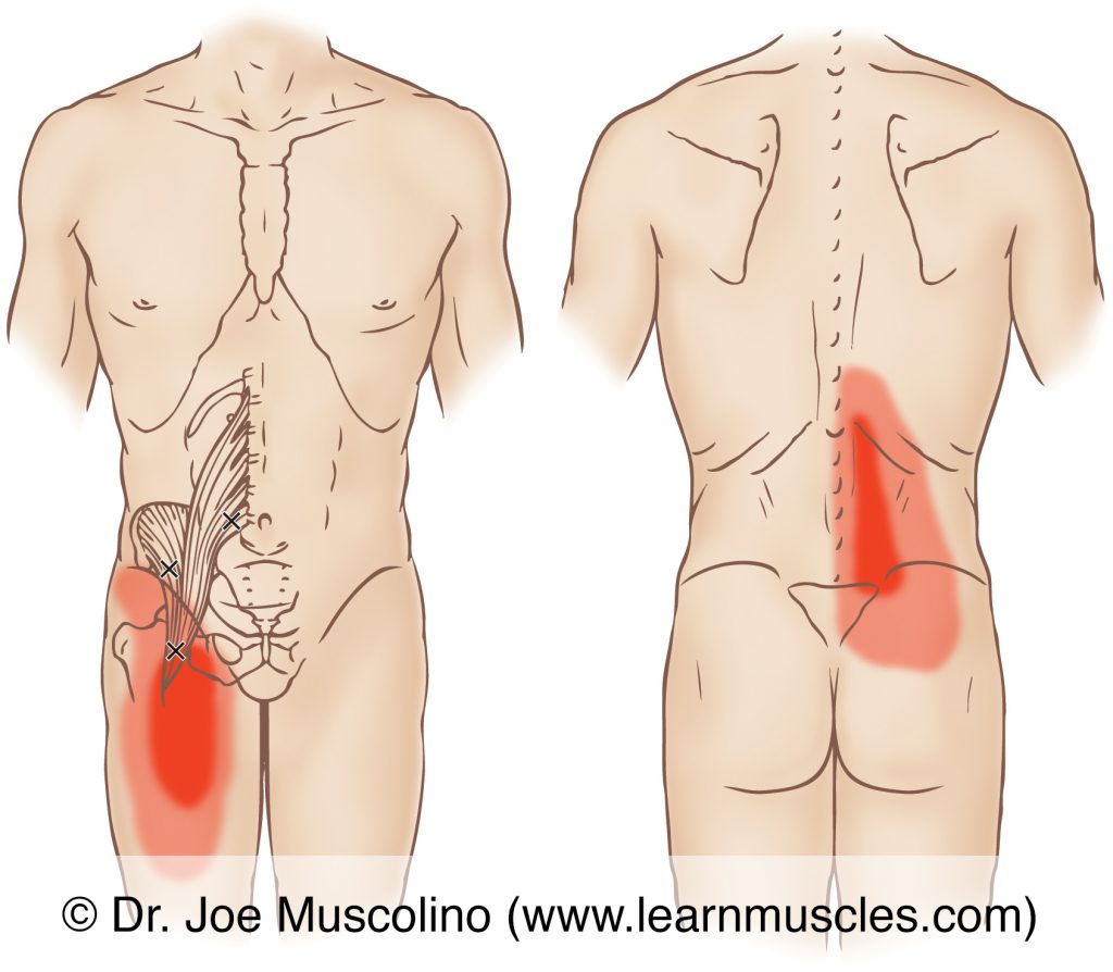Anterior and posterior views of myofascial trigger points in the right-side iliopsoas (iliacus and psoas major) and their corresponding referral zones.