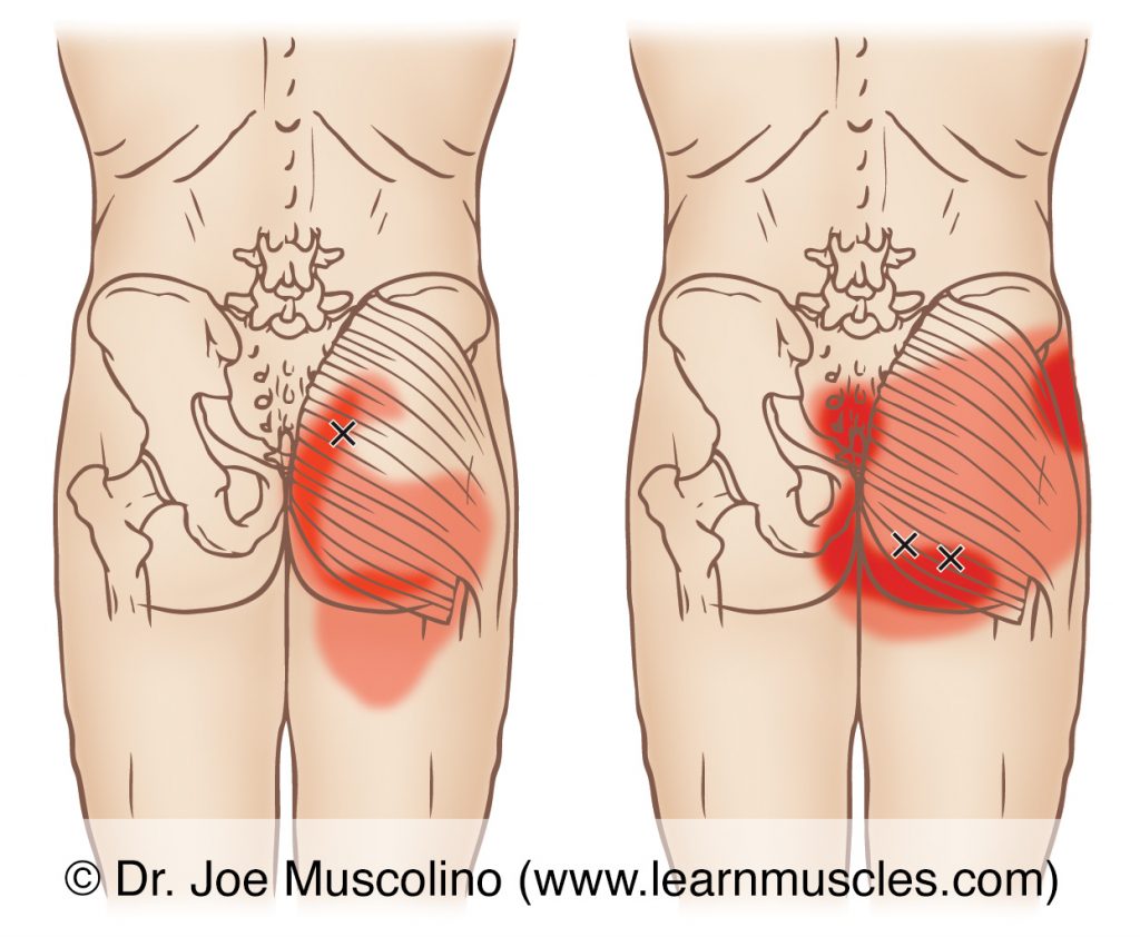 Posterior views of myofascial trigger points in the right-side gluteus maximus and their corresponding referral zones.