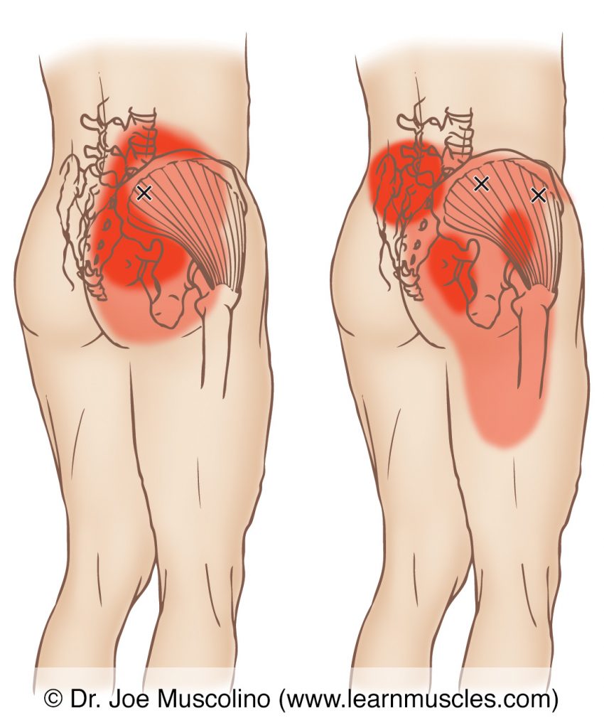 Posterolateral views of myofascial trigger points in the right-side gluteus medius and their corresponding referral zones.