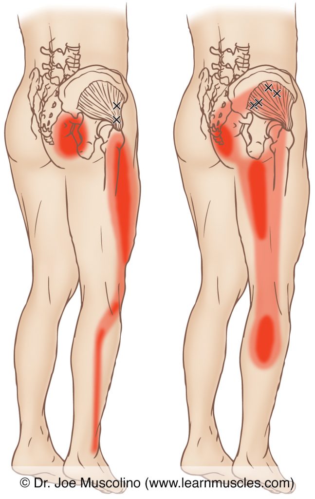 Posterolateral views of myofascial trigger points in the right-side gluteus minimus and their corresponding referral zones.