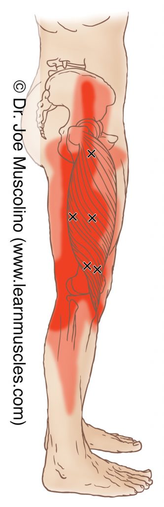 Lateral view of myofascial trigger points in the right-side vastus lateralis (of the quadriceps femoris group) and their corresponding referral zones.