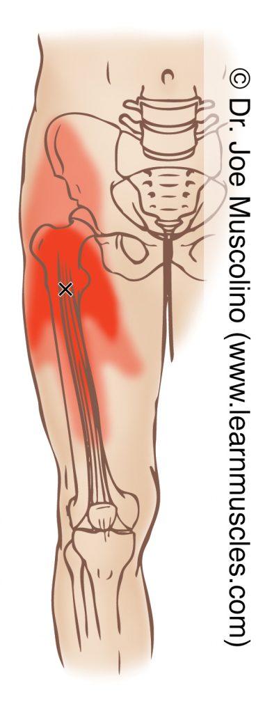 Anterior view of a myofascial trigger point in the right-side vastus intermedius (of the quadriceps femoris group) and its corresponding referral zone.