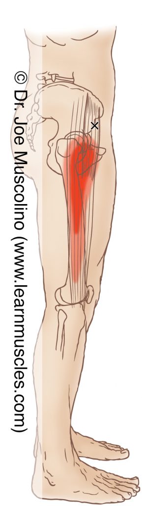 Lateral view of a myofascial trigger point in the right-side tensor fasciae latae (TFL) and its corresponding referral zone.