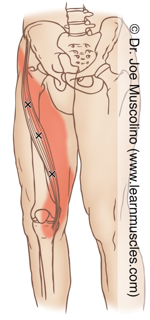 Anteromedial view of myofascial trigger points in the right-side sartorius and their corresponding referral zones.