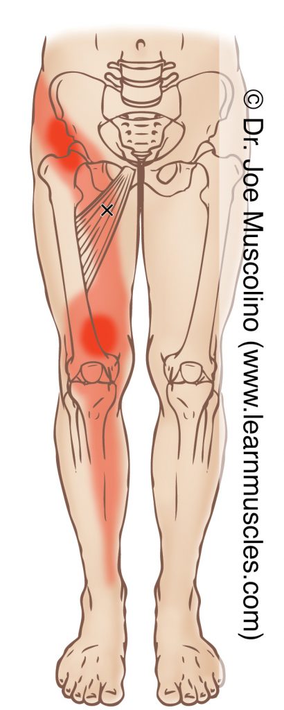 Anterior view of a myofascial trigger point in the right-side adductor longus and adductor brevis (of the adductor group) and its corresponding referral zone.