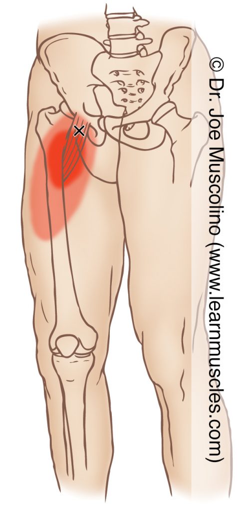 Anteromedial view of a myofascial trigger point in the right-side pectineus (of the adductor group) and its corresponding referral zone.