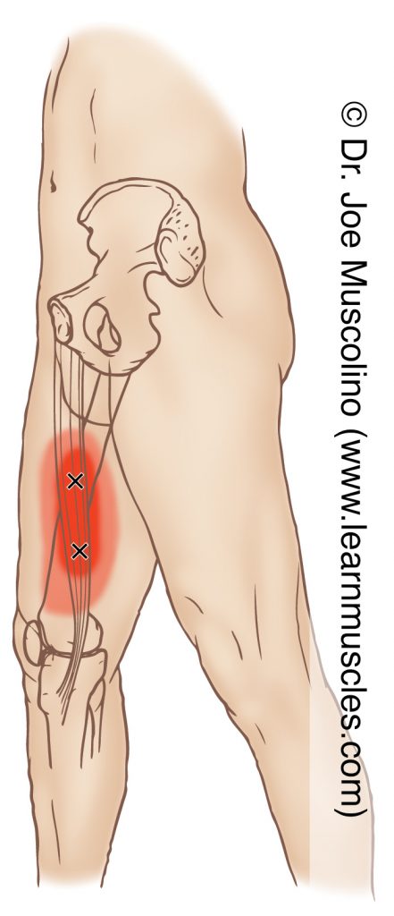 Medial view of myofascial trigger points in the right-side gracilis (of the adductor group) and their corresponding referral zones.