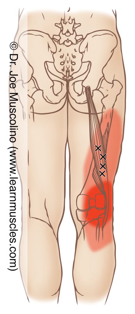 Posterior view of myofascial trigger points in the right-side biceps femoris (of the hamstring group) and their corresponding referral zones.