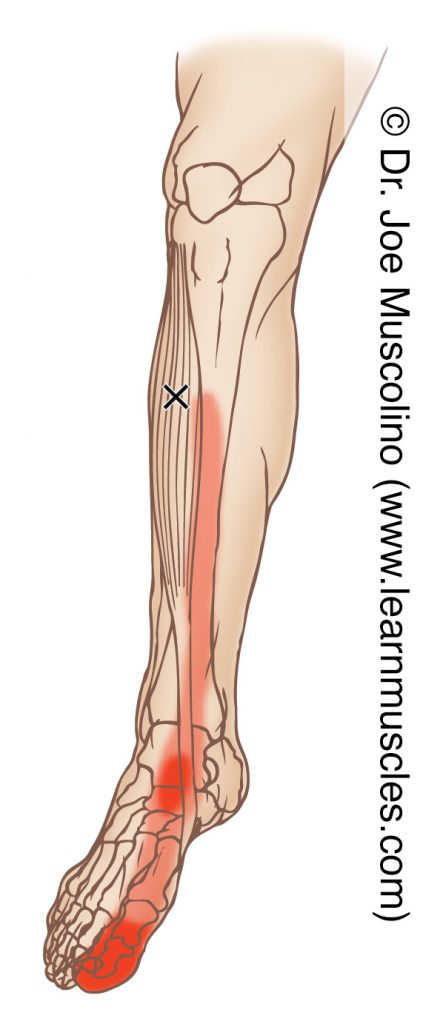 Anteromedial view of a myofascial trigger point in the right-side tibialis anterior and its corresponding referral zone.