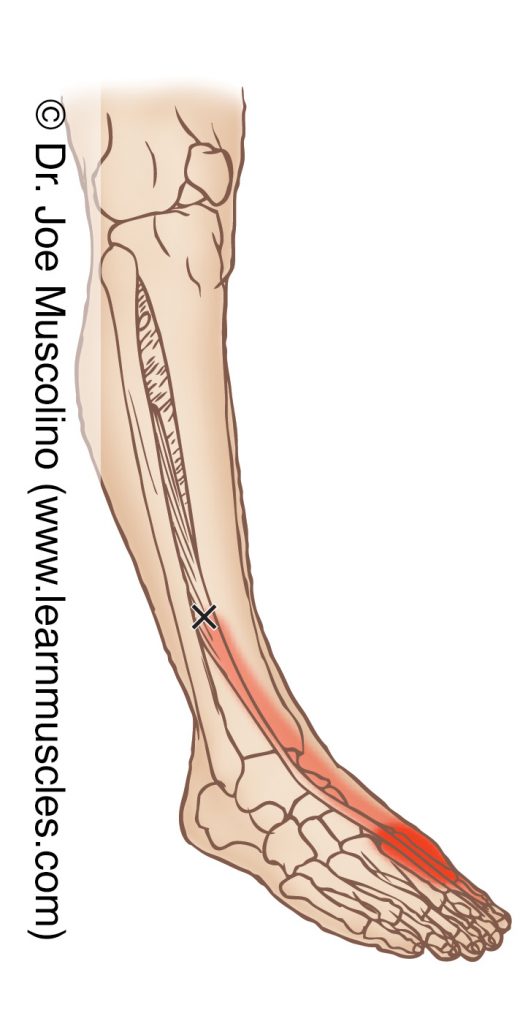 Anterolateral view of a myofascial trigger point in the right-side extensor hallucis longus and its corresponding referral zone.