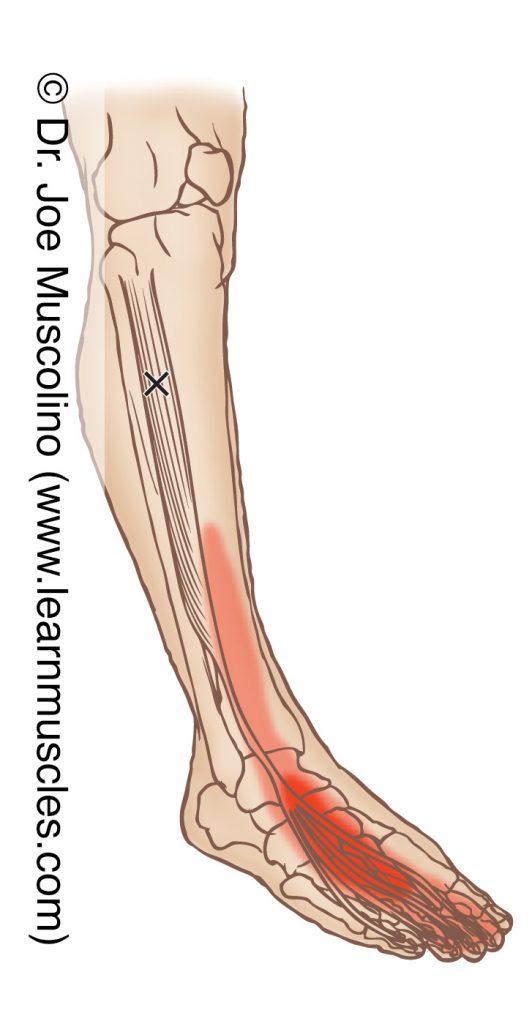 Anterolateral view of a myofascial trigger point in the right-side extensor digitorum longus and its corresponding referral zone.