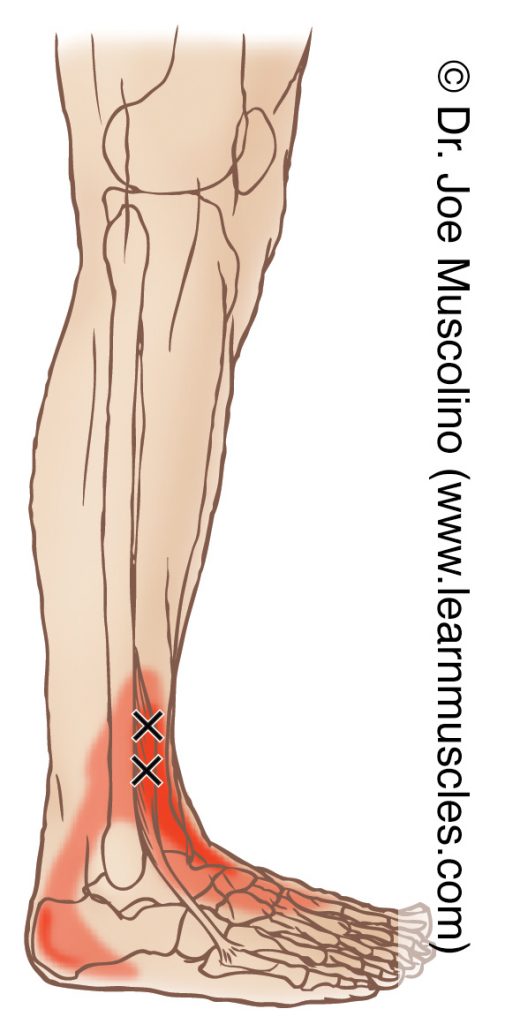 Lateral view of a myofascial trigger point in the right-side fibularis tertius and its corresponding referral zone.