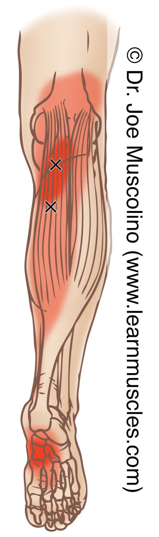 Gastrocnemius Trigger Points Learn Muscles