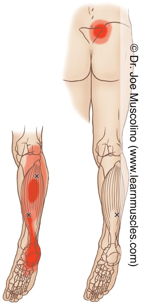 Posterior views of myofascial trigger points in the right-side soleus and their corresponding referral zones.