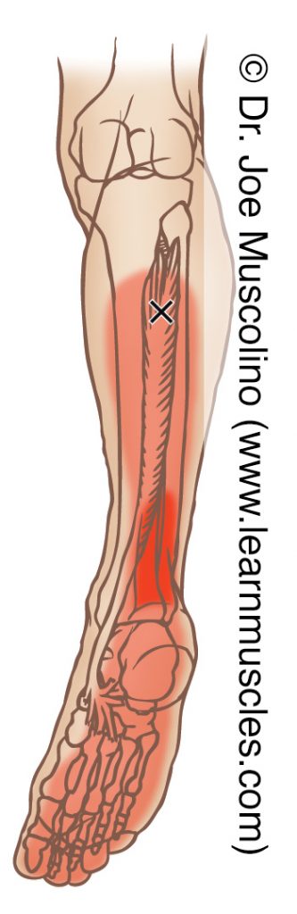 Posterior view of a myofascial trigger point in the right-side tibialis posterior and its corresponding referral zone.
