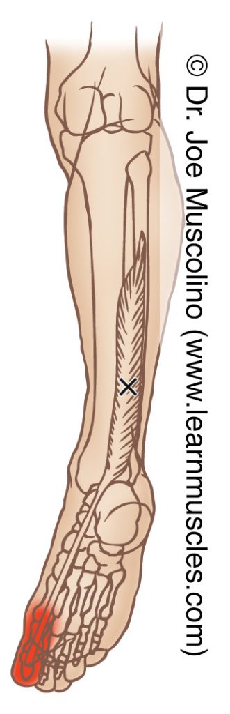 Posterior view of a myofascial trigger point in the right-side flexor hallucis longus and its corresponding referral zone.
