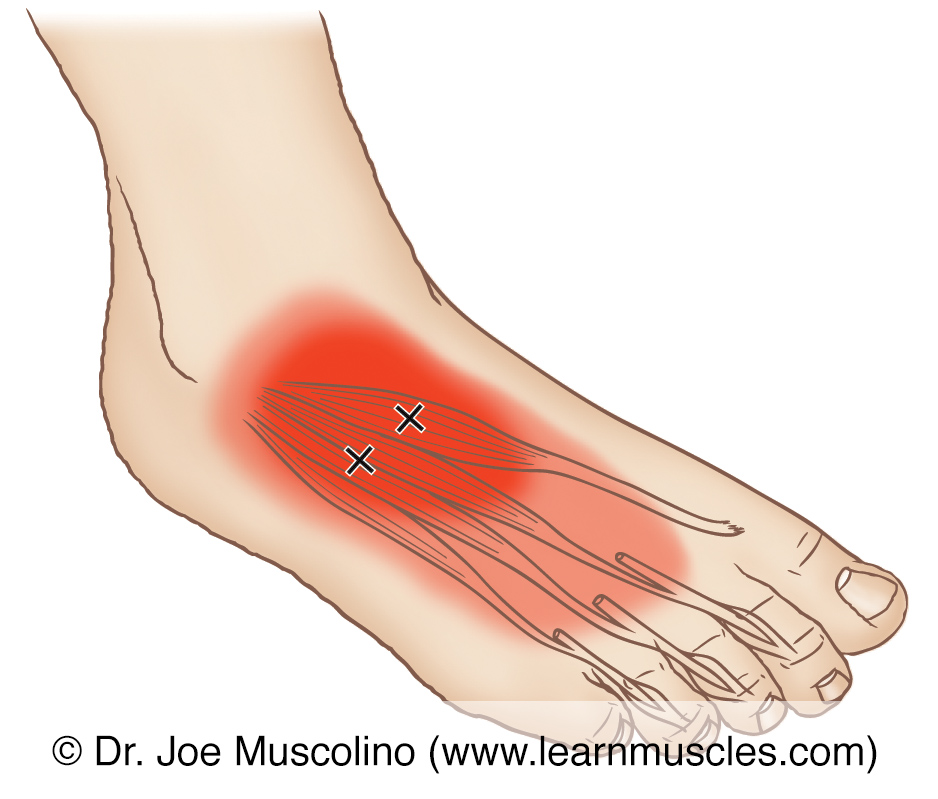 Extensor Digitorum Longus Muscle Pain TJHA Extensor Digitorum Longus Muscle Pain TJHA