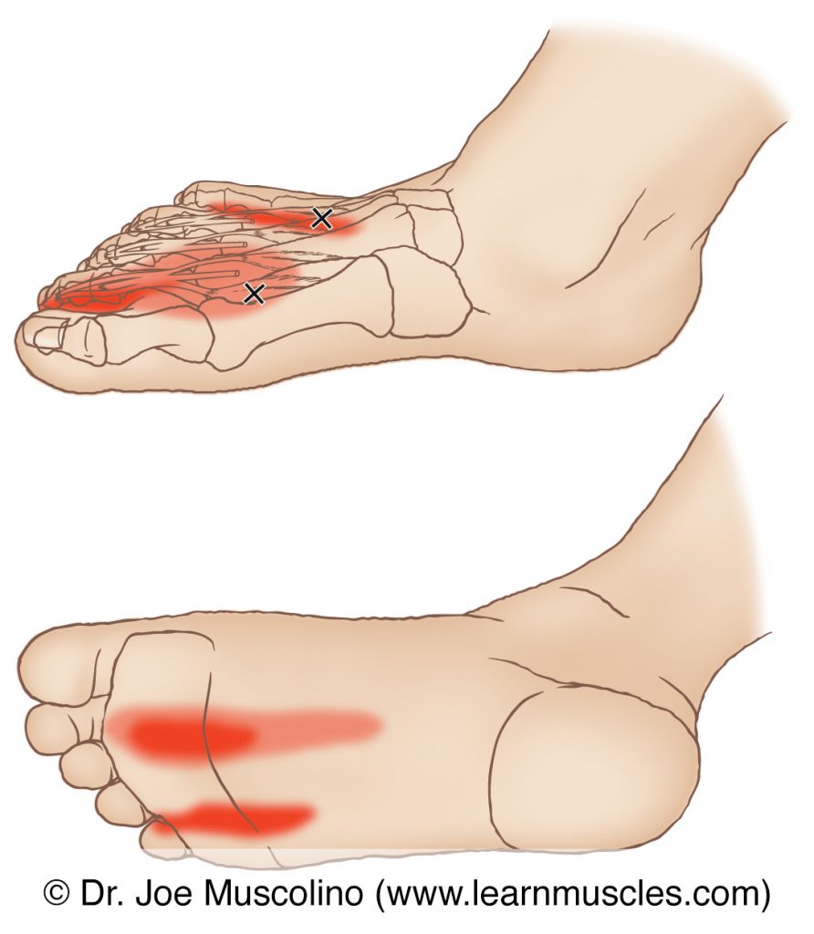 Dorsomedial and plantar views of myofascial trigger points in the right-side dorsal interossei pedis and their corresponding referral zones.