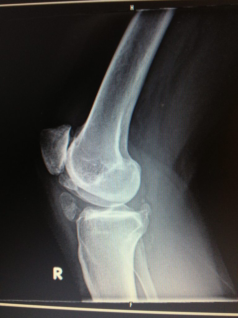 Knee OA pre-surgery - lat view