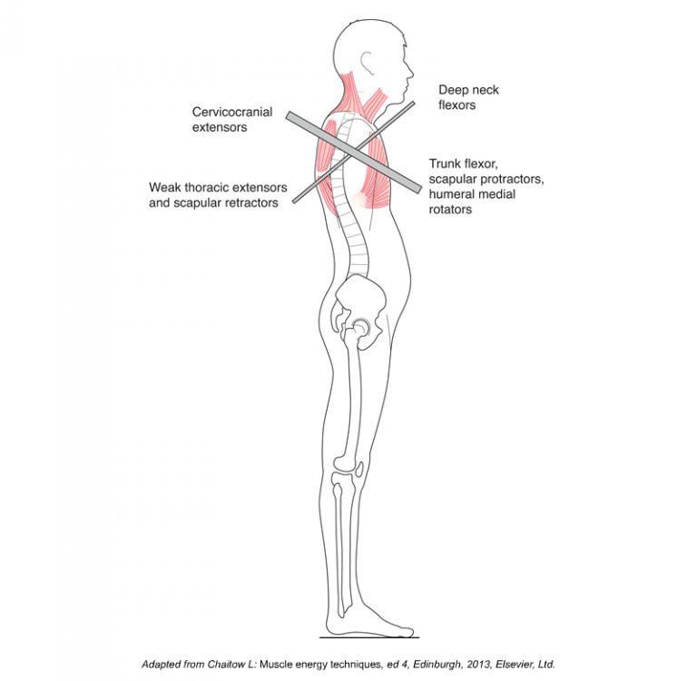 What is Upper Crossed Syndrome and what are its causes?