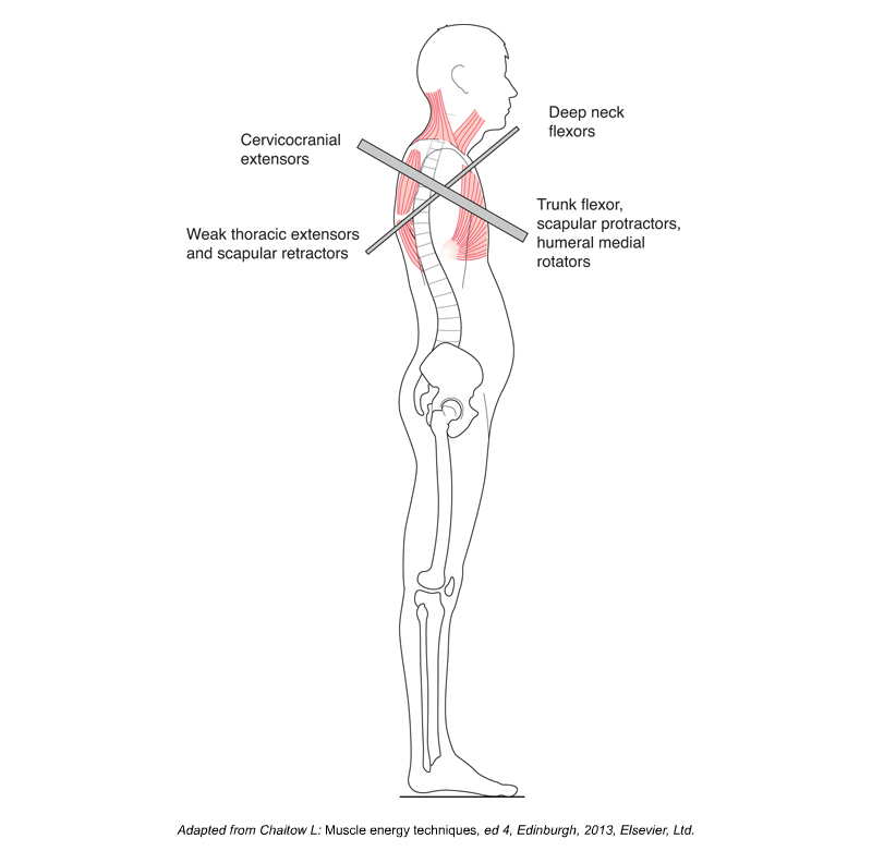 Upper Crossed Syndrome. Permission Joseph E. Muscolino. Kinesiology - The Skeletal System and Muscle Function, 3ed (Elsevier, 2017). 
