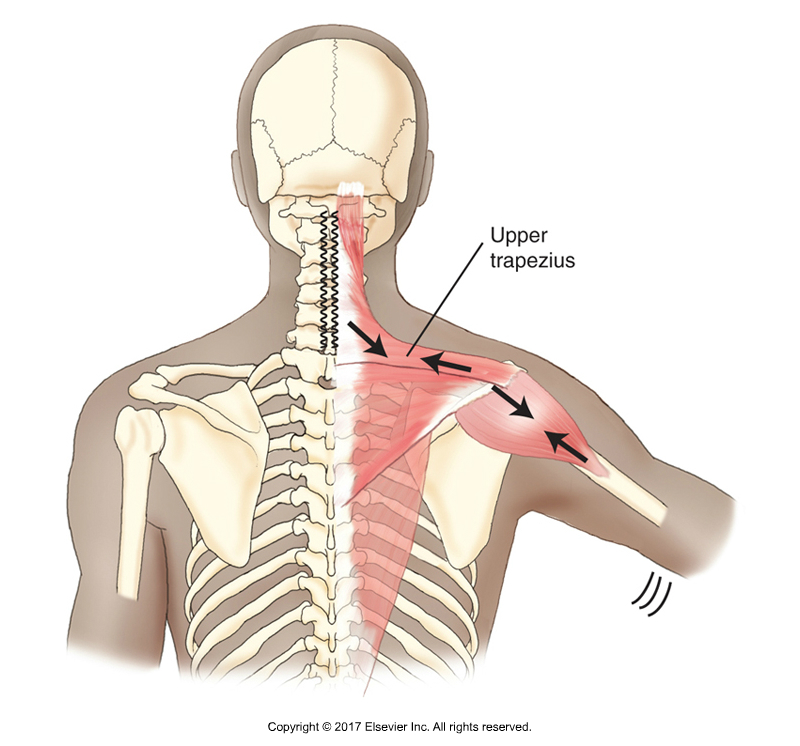 Upper trapezius stabilizing the scapula against the pull of the deltoid. Permission Joseph E. Muscolino. Kinesiology - The Skeletal System and Muscle Function, 3rd ed. (Elsevier, 2017).
