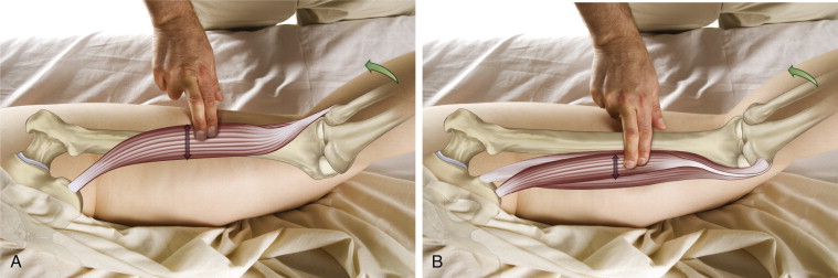 Hamstring Palpation. Permission Joseph E. Muscolino. The Muscle and Bone Palpation Manual - with Trigger Points, Referral Patterns, and Stretching, 2 ed. (Elsevier, 2016).