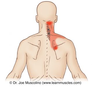 Multifidus (Cervical) - Trigger Points - Learn Muscles