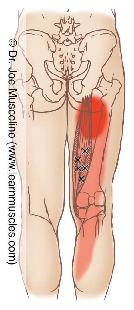 Posterior view of myofascial trigger points in the right-side semitendinosus and semimembranosus (of the hamstring group) and their corresponding referral zones.