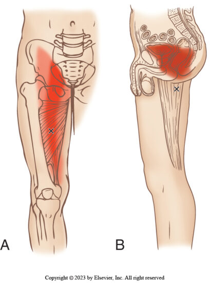 4th Hamstring Adductor Magnus: The 4th Hamstring, Attachments, Functions & Palpation ...