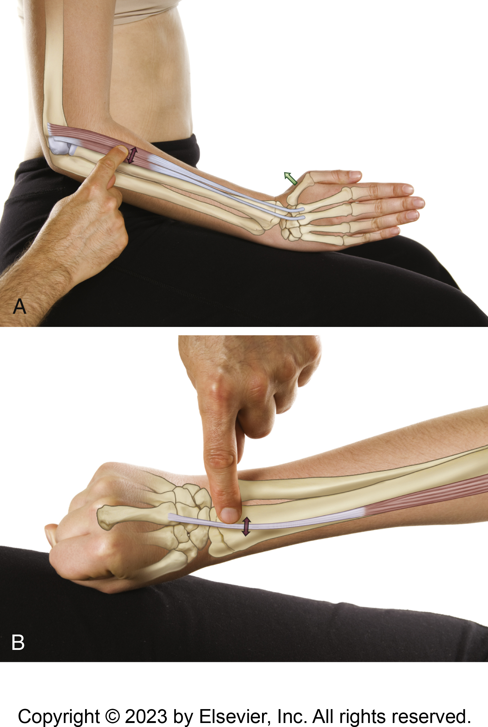 Extensor Carpi Radialis Brevis and Tennis Elbow