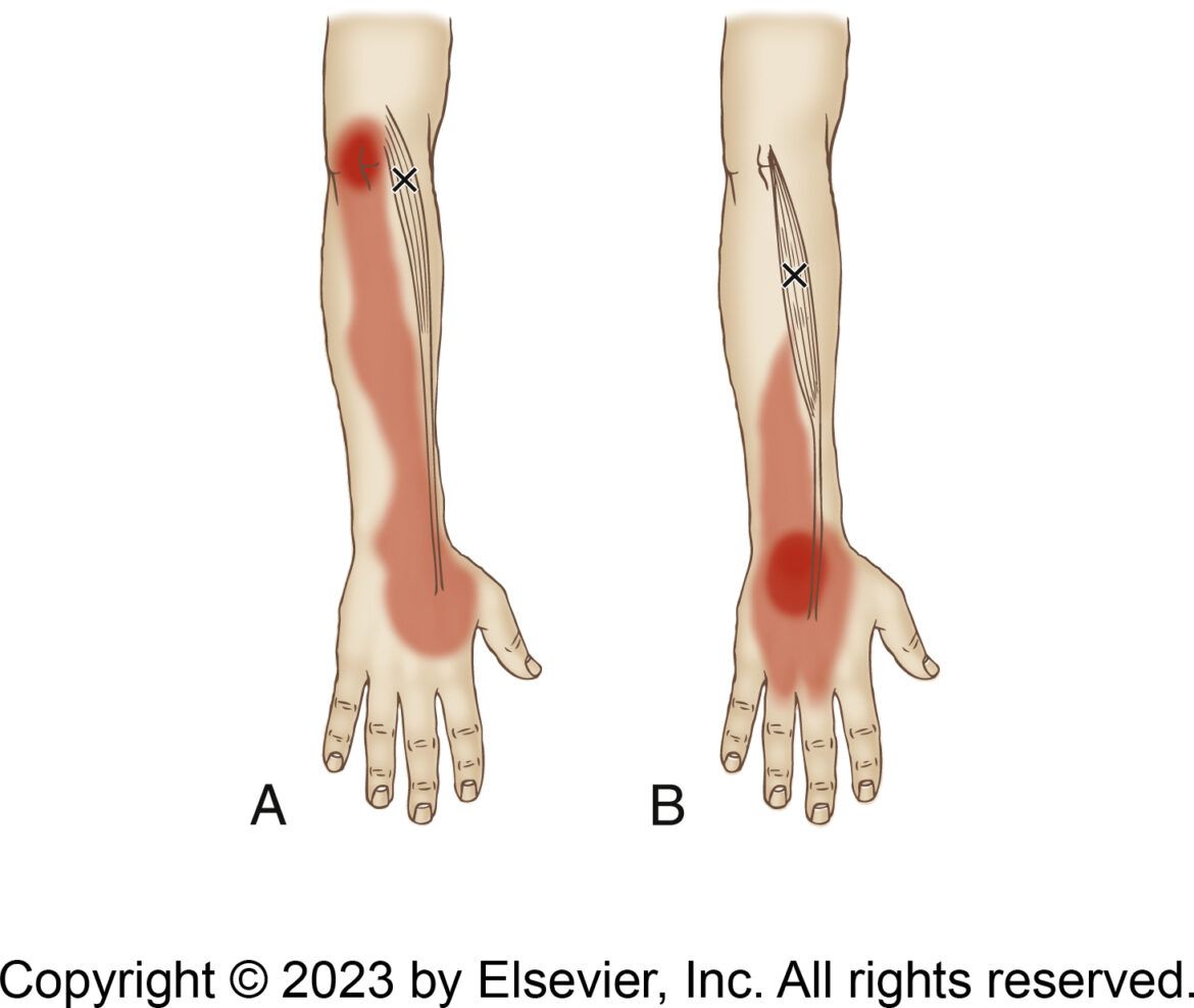 Extensor Carpi Radialis Brevis and Tennis Elbow
